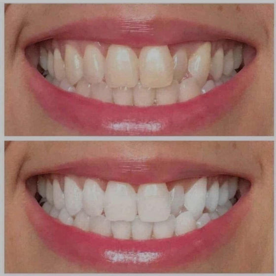Ultraviolet pearly white teeth whitening gel